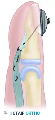 Fig. 66-29 ). If several tendon ends are to be fixed to bone, they are best inserted into a large hole drilled in the bone.