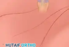 Zone I Distal to sublimis