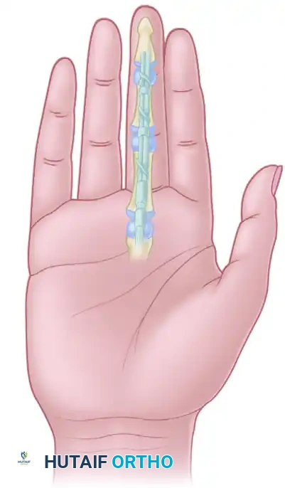 Masterclass in Flexor Tendon Repair: Timing, Anatomy, and Surgical Techniques