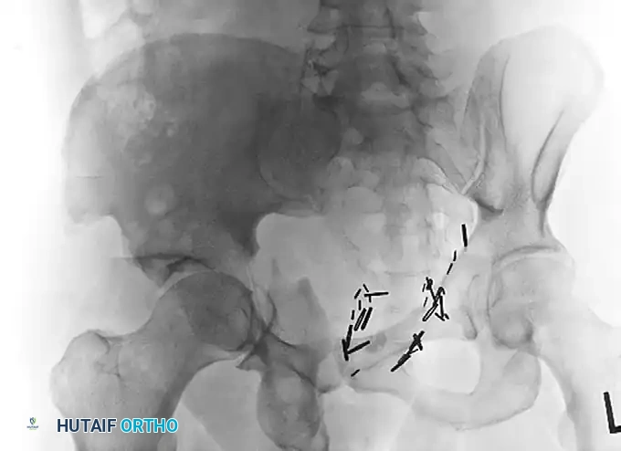 TOTAL HIP ARTHROPLASTY AS TREATMENT OF ACETABULAR FRACTURE Surgical Diagram