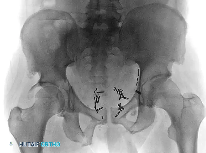 TOTAL HIP ARTHROPLASTY AS TREATMENT OF ACETABULAR FRACTURE Surgical Diagram