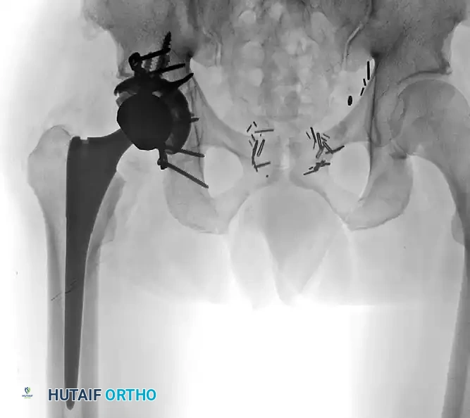 TOTAL HIP ARTHROPLASTY AS TREATMENT OF ACETABULAR FRACTURE Surgical Diagram
