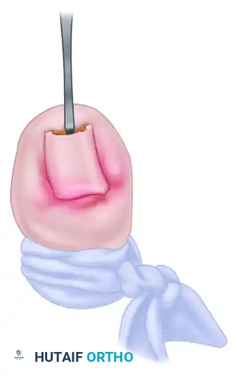 FIGURE 87-6 A and B, Turned up pulp deformity after multi­ ple nail avulsions for treatment of ingrown toenail. C, Turned up deformity after several nail avulsions. SEE TECHNIQUE 87-1 .