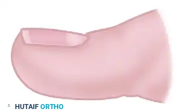 TOTAL NAIL PLATE REMOVAL Surgical Diagram