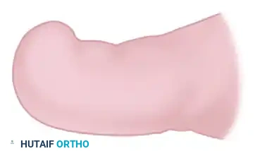 TOTAL NAIL PLATE REMOVAL Surgical Diagram