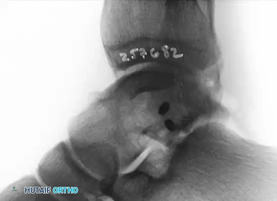 TRANSCHONDRAL FRACTURES OF THE TALUS Surgical Diagram