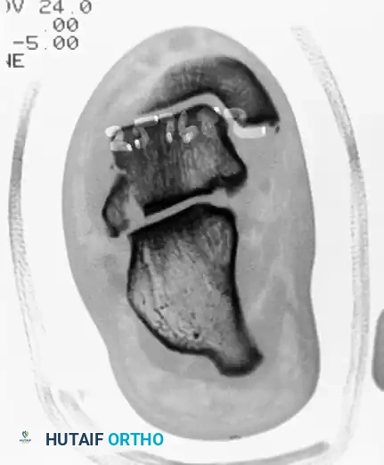TRANSCHONDRAL FRACTURES OF THE TALUS Surgical Diagram