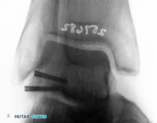 TRANSCHONDRAL FRACTURES OF THE TALUS Surgical Diagram