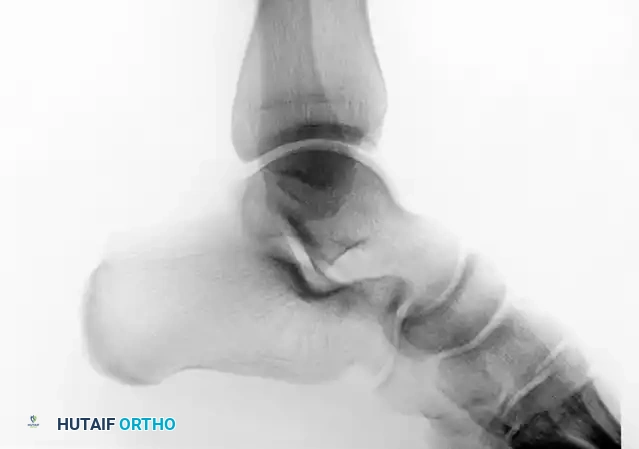 TRANSCHONDRAL FRACTURES OF THE TALUS Surgical Diagram