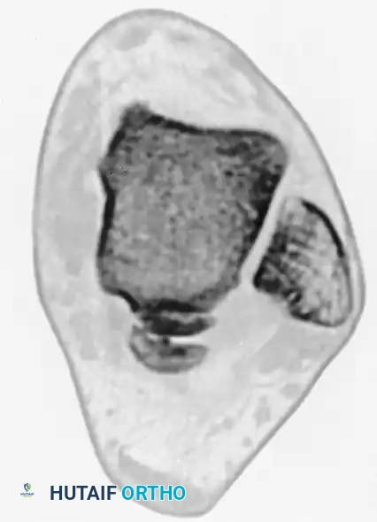 TRANSCHONDRAL FRACTURES OF THE TALUS Surgical Diagram