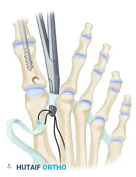 TRANSFER OF EXTENSOR HALLUCIS LONGUS WITH ARTHRODESIS OF THE INTERPHALANGEAL JOINT OF THE HALLUX Surgical Diagram