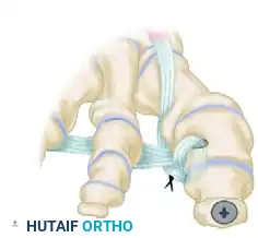 TRANSFER OF EXTENSOR HALLUCIS LONGUS WITH ARTHRODESIS OF THE INTERPHALANGEAL JOINT OF THE HALLUX Surgical Diagram