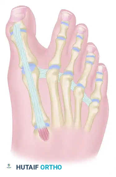 TRANSFER OF EXTENSOR HALLUCIS LONGUS WITH ARTHRODESIS OF THE INTERPHALANGEAL JOINT OF THE HALLUX Surgical Diagram