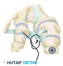 TRANSFER OF EXTENSOR HALLUCIS LONGUS WITH ARTHRODESIS OF THE INTERPHALANGEAL JOINT OF THE HALLUX Surgical Diagram
