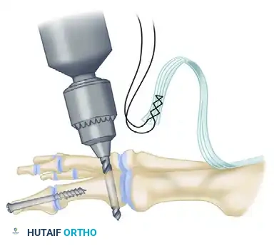 TRANSFER OF EXTENSOR HALLUCIS LONGUS WITH ARTHRODESIS OF THE INTERPHALANGEAL JOINT OF THE HALLUX Surgical Diagram