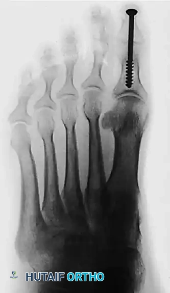 TRANSFER OF EXTENSOR HALLUCIS LONGUS WITH ARTHRODESIS OF THE INTERPHALANGEAL JOINT OF THE HALLUX Surgical Diagram