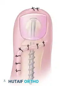 TRANSFER OF EXTENSOR HALLUCIS LONGUS WITH ARTHRODESIS OF THE INTERPHALANGEAL JOINT OF THE HALLUX Surgical Diagram