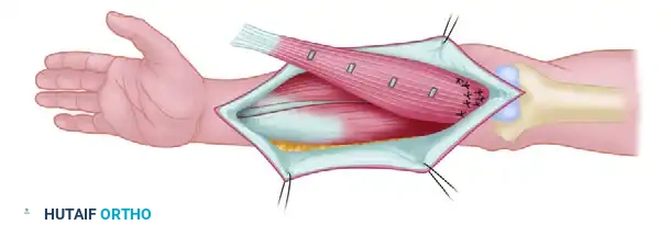 Free Functioning Muscle Transfer & Vascularized Bone Grafts