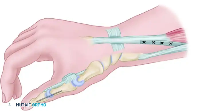 Brachioradialis to ECRB Transfer & Key Pinch Restoration