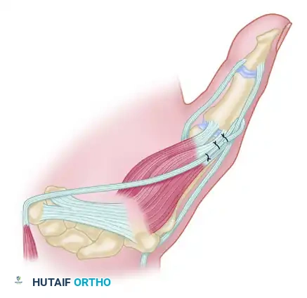 TRANSFER OF THE EXTENSOR INDICIS PROPRIUS Surgical Diagram