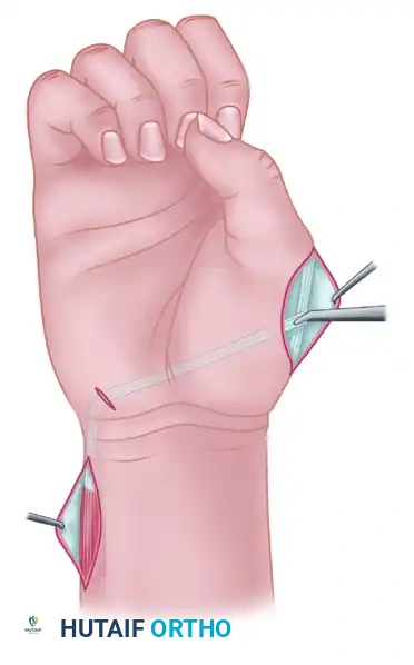 TRANSFER OF THE EXTENSOR INDICIS PROPRIUS Surgical Diagram