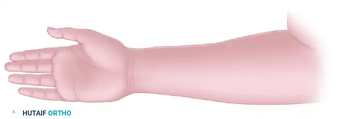 TRANSFER OF THE FLEXOR CARPI ULNARIS Surgical Diagram