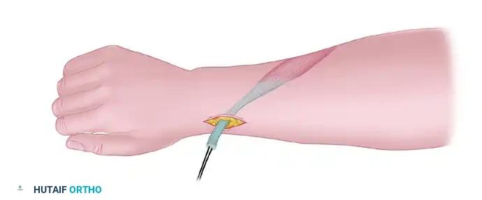 TRANSFER OF THE FLEXOR CARPI ULNARIS Surgical Diagram