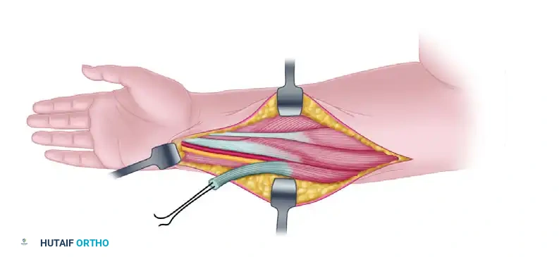 TRANSFER OF THE FLEXOR CARPI ULNARIS Surgical Diagram