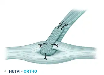 TRANSFER OF THE FLEXOR CARPI ULNARIS Surgical Diagram