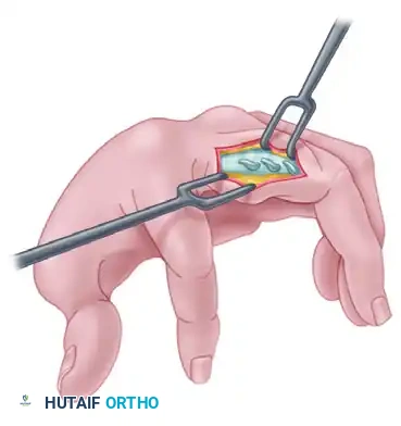 TRANSFER OF THE FLEXOR DIGITORUM SUBLIMIS OF THE RING FINGER Surgical Diagram