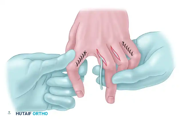 Masterclass in Tendon Transfers: The Modified Bunnell Flexor Digitorum Sublimis Transfer