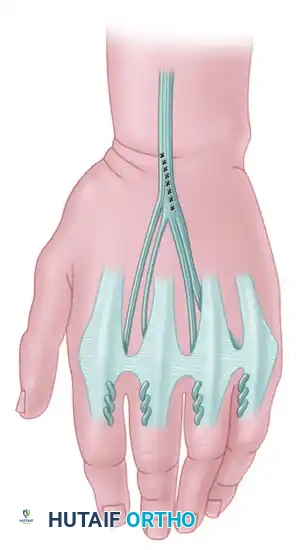 TRANSFER OF THE FLEXOR DIGITORUM SUBLIMIS OF THE RING FINGER Surgical Diagram
