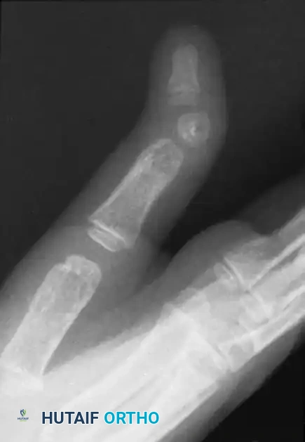 Radiographic appearance of delta phalanx