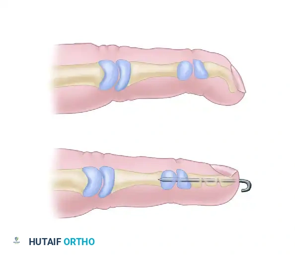 Carstam and Eiken correction of Kirner deformity