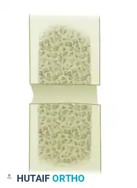 TRANSFER OF THE PRONATOR TERES Surgical Diagram