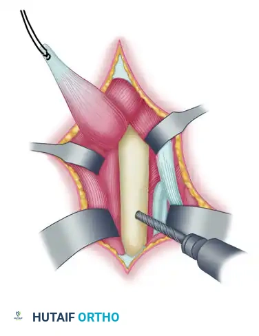 TRANSFER OF THE PRONATOR TERES Surgical Diagram