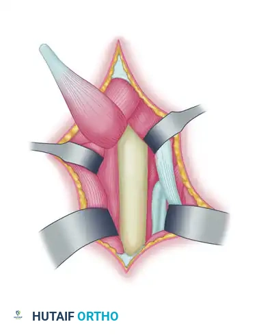 TRANSFER OF THE PRONATOR TERES Surgical Diagram