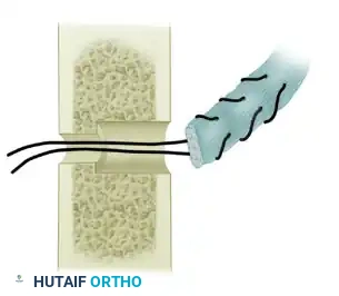 Pronator Teres Rerouting and Transfer: Comprehensive Surgical Guide