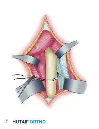 TRANSFER OF THE PRONATOR TERES Surgical Diagram