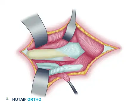 TRANSFER OF THE PRONATOR TERES Surgical Diagram