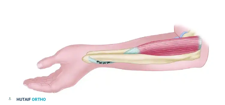 TRANSFER OF THE PRONATOR TERES Surgical Diagram