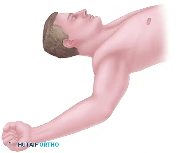 TRANSFER OF THE ULNAR NERVE FASCICLES TO NERVE OF THE BICEPS MUSCLE Surgical Diagram