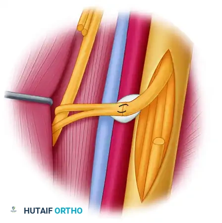 TRANSFER OF THE ULNAR NERVE FASCICLES TO NERVE OF THE BICEPS MUSCLE Surgical Diagram
