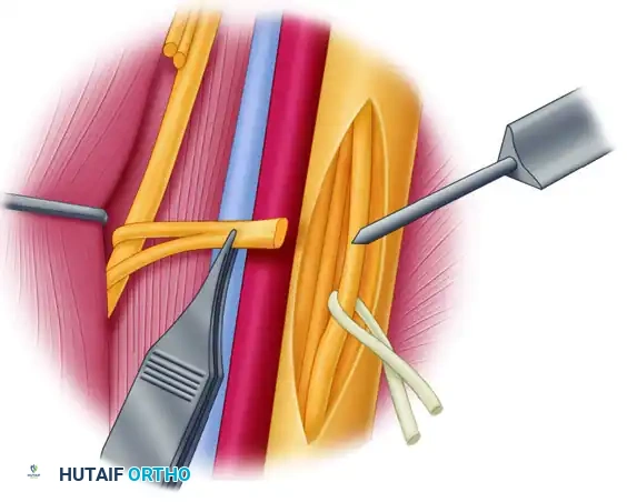 TRANSFER OF THE ULNAR NERVE FASCICLES TO NERVE OF THE BICEPS MUSCLE Surgical Diagram