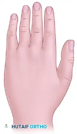 Volar sensory distribution of median nerve