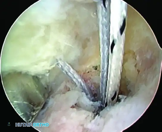 TRANSTENDINOUS REPAIR OF A PARTIAL ARTICULAR-SIDE SUPRASPINATUS TENDON AVULSION LESION Surgical Diagram