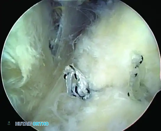 TRANSTENDINOUS REPAIR OF A PARTIAL ARTICULAR-SIDE SUPRASPINATUS TENDON AVULSION LESION Surgical Diagram