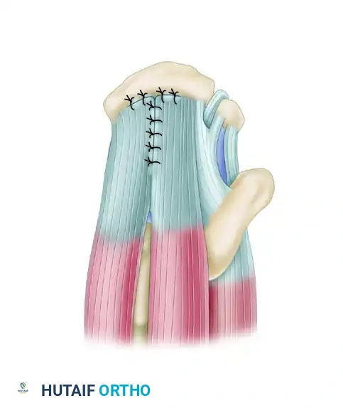 TRANSTENDINOUS REPAIR OF A PARTIAL ARTICULAR-SIDE SUPRASPINATUS TENDON AVULSION LESION Surgical Diagram