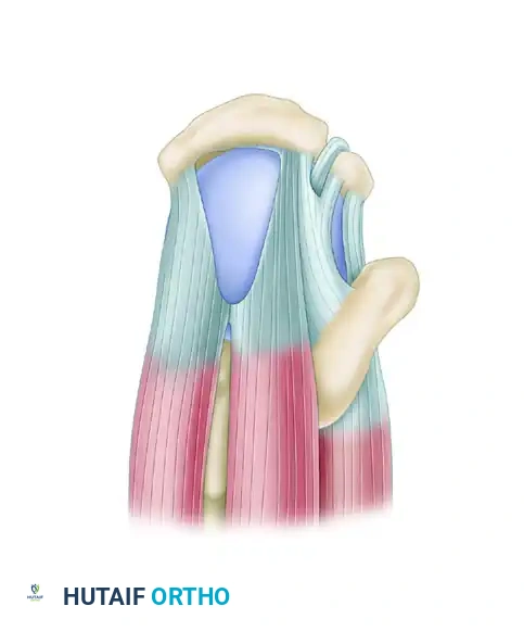 TRANSTENDINOUS REPAIR OF A PARTIAL ARTICULAR-SIDE SUPRASPINATUS TENDON AVULSION LESION Surgical Diagram