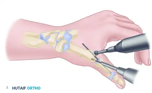 TRAPEZIOMETACARPAL ARTHRODESIS Surgical Diagram